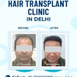 Hair transplant clinic in Delhi NCR