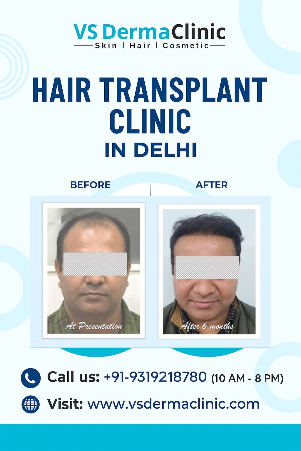 Hair transplant clinic in Delhi NCR