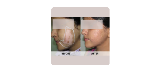 Vitiligo Surgery