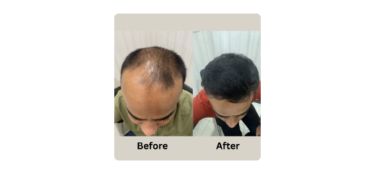 Hair Transplantation