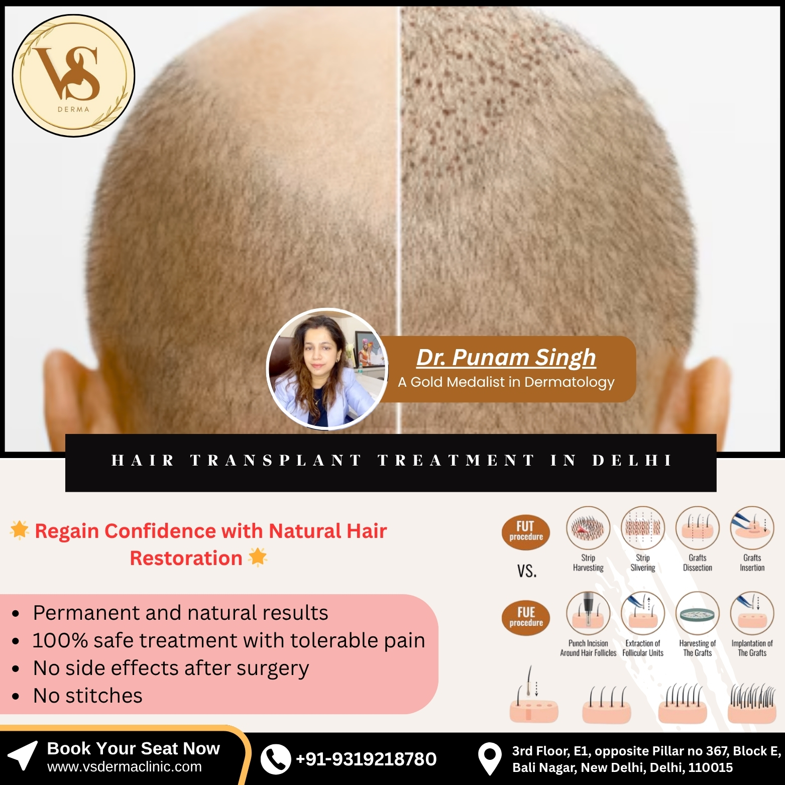 Advanced Hair Transplant Treatment in Delhi at VS Derma Clinic