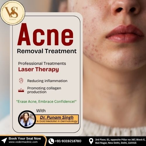 Say Goodbye to Acne – Forever